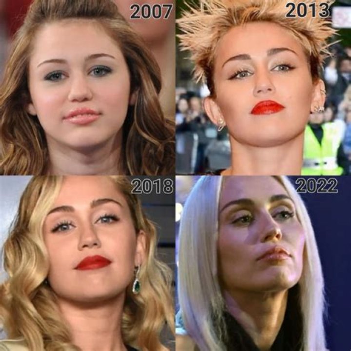 Miley Cyrus' Buccal Fat Removal Journey
